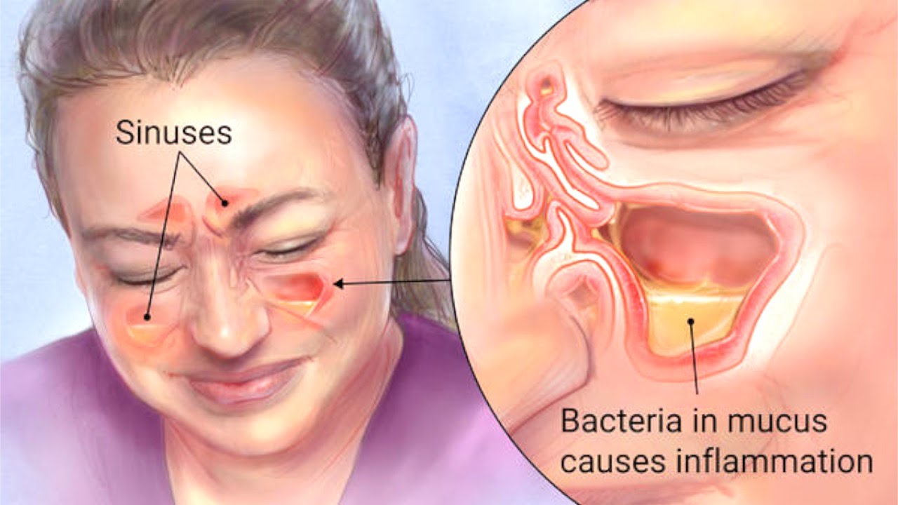 PunjabKesari, Sinus Infection Image,साइनस (साइनोसाइटिस) इन्फेक्शन इमेज 