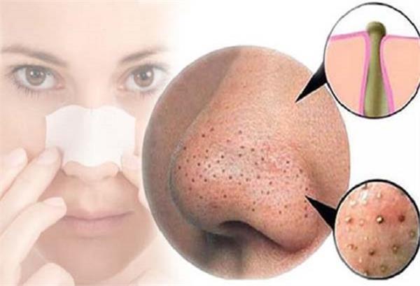 PunjabKesari, Pimples types Image, Pimples home remedy Image