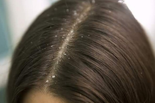 PunjabKesari,nari, dandruff