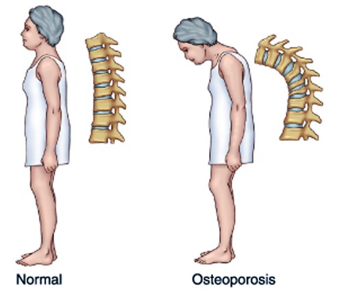 PunjabKesari, Osteoporosis caldition