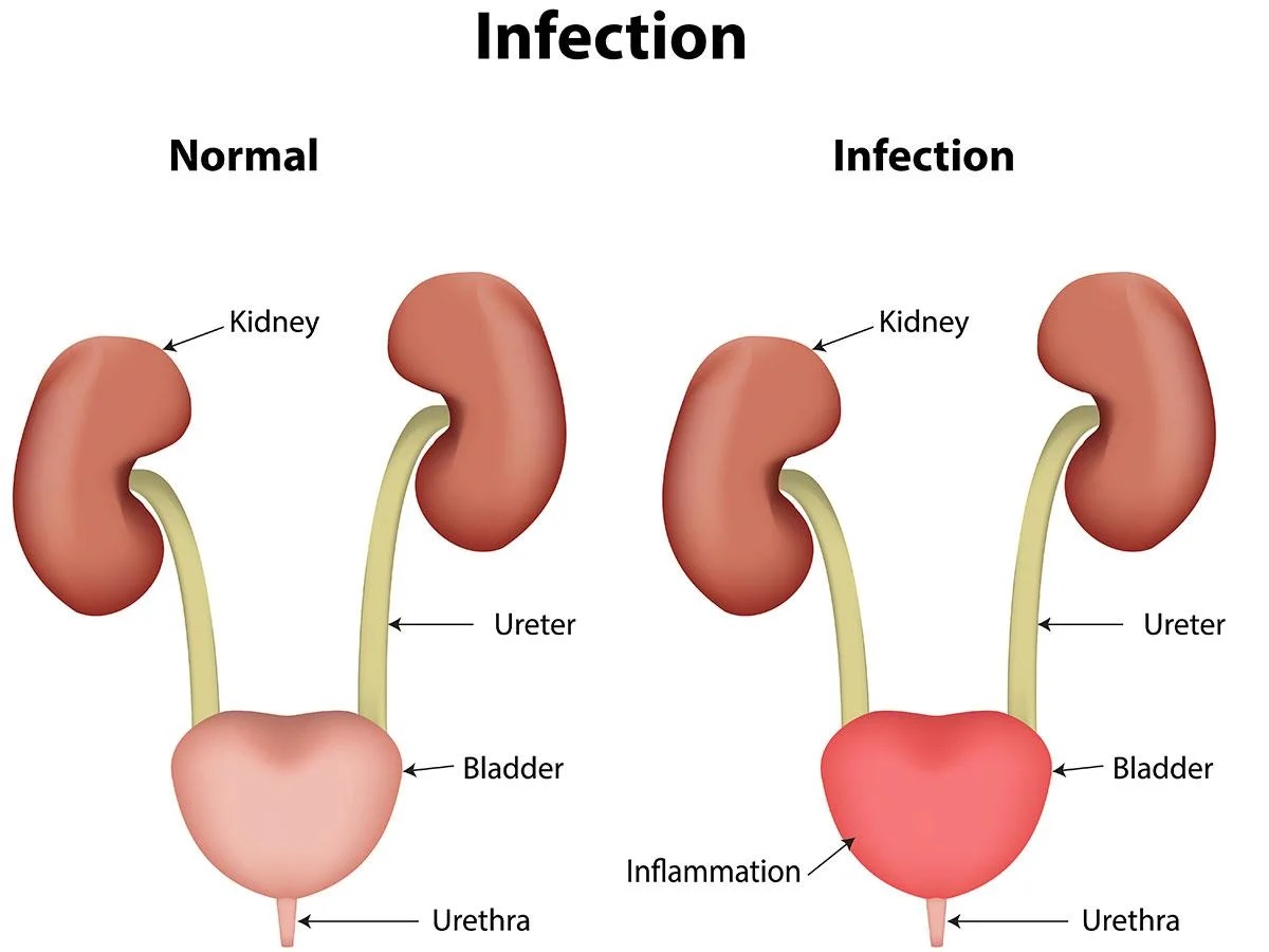 PunjabKesari, UTI Infection Nari