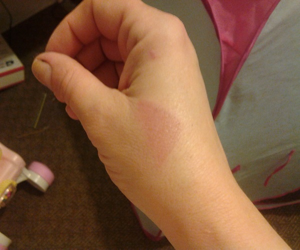 जली हुई त्वचा की एेसे करें देखभाल