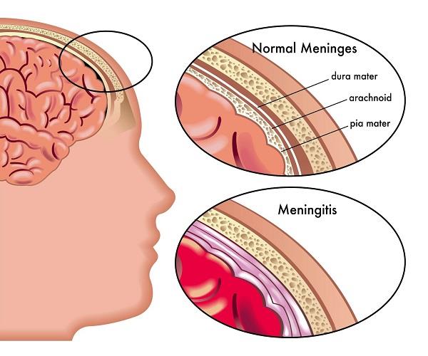 मेनिनजाइटिस के 6 लक्षण, सभी पेरेंट्स को होनी चाहिए इनकी जानकारी