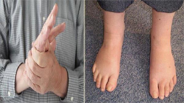 सर्दियों में सूज जाती हैं हाथ-पैर की उंगलियां तो अजमाएं ये टिप्स