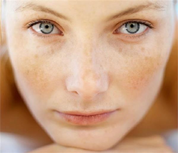 झाइयों से हैं परेशान तोे आजमाएं ये घरेलू नुस्खे