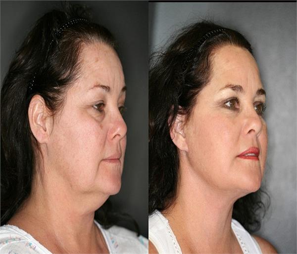 ढीली पड़ चुकी त्वचा पर कसाव लाएंगी ये चीजें