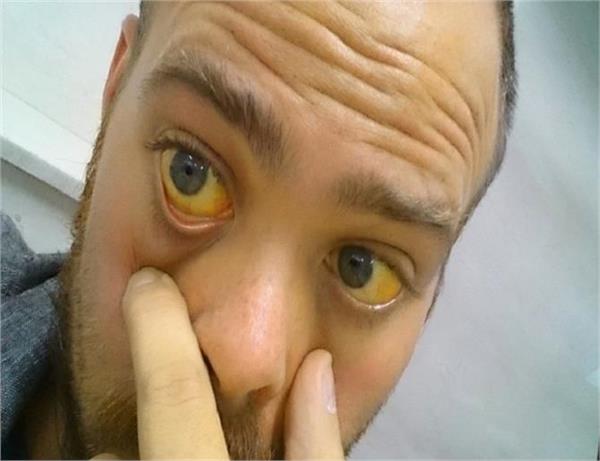 पीलिया होने पर अपनाएं ये घरेलू उपचार