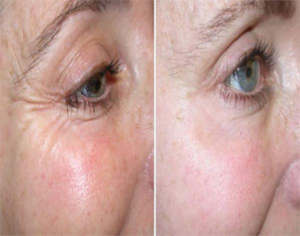 आंखों के अासपास की झुर्रियों को कम करते हैं ये असरदार नुस्खे