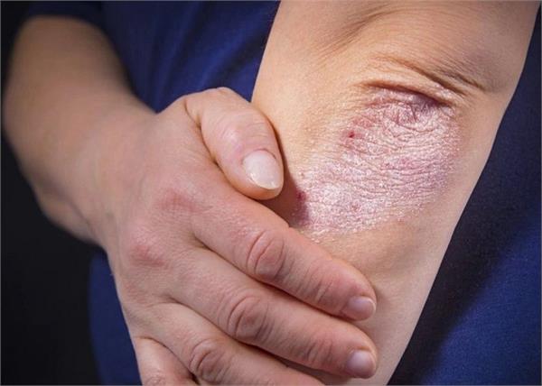सोरायसिस प्रॉब्लम है तो सर्दियों में यूं करें स्किन केयर