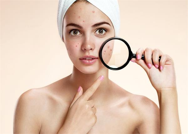 कहीं मुहांसों का कारण आपकी गलत डाइट तो नहीं? जानें क्या खाएं और किसे कहें 'ना'