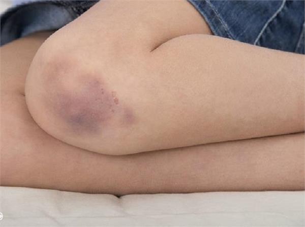क्या आपकी त्वचा पर भी पड़ जाते हैं नील तो कैसे करें इनका उपचार? - how-to-remove-body-bruise-marks - Nari Punjab Kesari