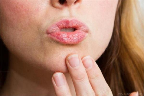सर्दियों में क्यों बार-बार फटते हैं होंठ और कैसे करें इसका उपचार?