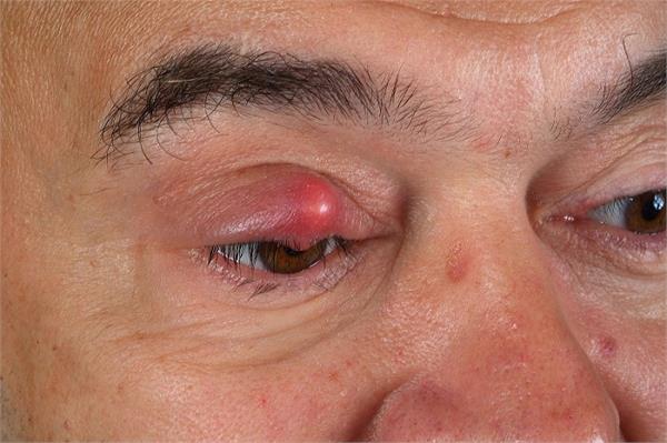 गुहेरी की समस्या को 2 दिन में खत्म करते है ये घरेलू नुस्खे