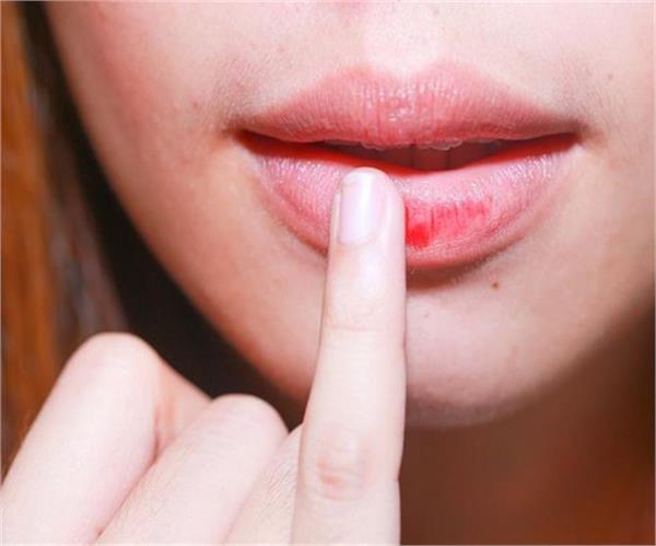 होठों का कालापन दूर करने के लिए करें ये उपाय