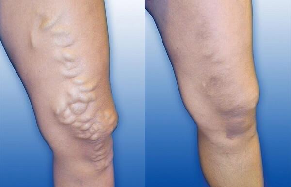 नसों में सूजन का कारण बनती हैं आपकी ये 5 आदतें