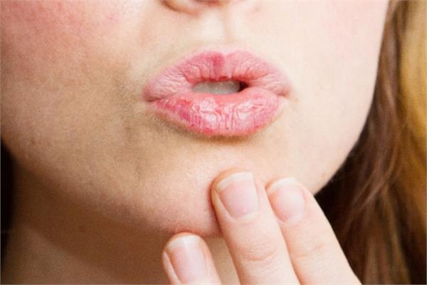 फटे होंठों की परेशानी को मिनटों में दूर करेंगे ये 10 घरेलू टिप्स