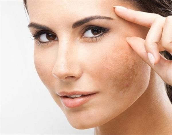 झाइयों की वजह से गोरी स्किन भी हो गई है काली तो इस तरह लगाएं नींबू