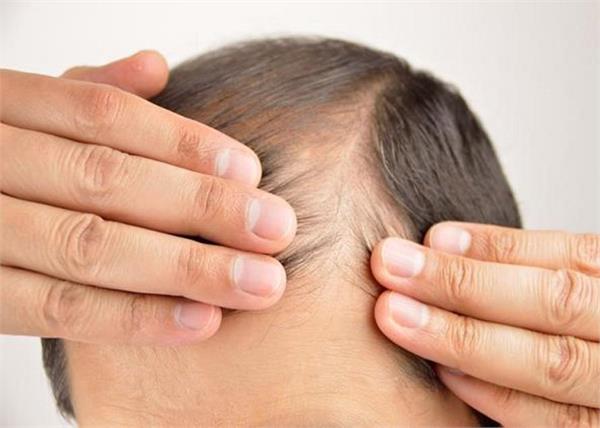 पुरुषों में बाल झड़ने के कारण है ये गलतियां