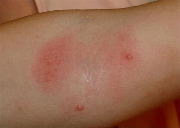 फोड़े-फुंसी का इलाज करें इन घरेलू तरीकों से