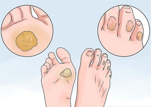 7 दिन में इन होममेड चीजों से पाएं फुट कॉर्न्स से छुटकारा!