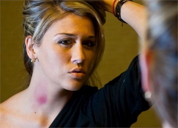 मिनटों में गायब हो जाएंगे 'लव बाइट' के निशान, करें ये आसान काम