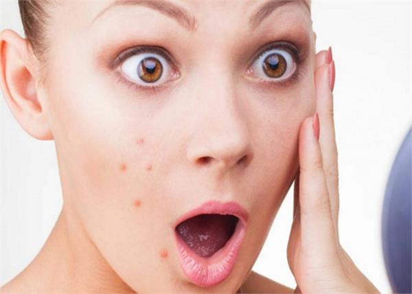 आपकी इन्हीं 10 गलतियों के कारण निकलते हैं पिंपल्स
