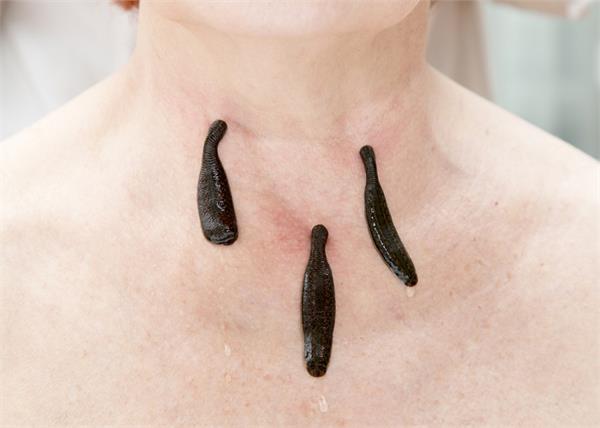 गंजापन दूर करना हो या डायबिटीज, जोंक थेरेपी करेगी पक्का इलाज