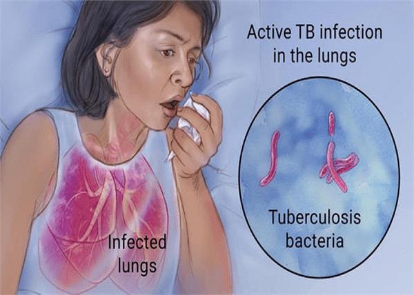 World TB Day: सिर्फ खांसी ही नहीं, ये 10 लक्षण भी देते हैं टीबी का संकेत