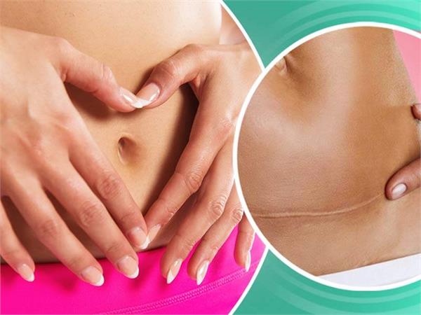 सिजेरियन डिलिवरी के बाद Periods में आते हैं 5 बदलाव