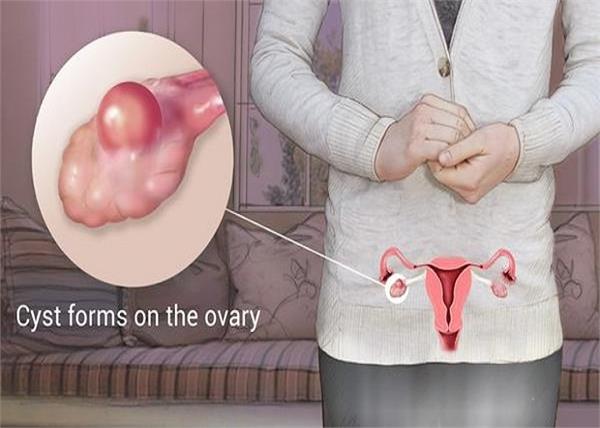 Women Health: क्यों बनते हैं ओवेरियन सिस्ट? जानिए, संकेत से लेकर बचाव की पूरी जानकारी
