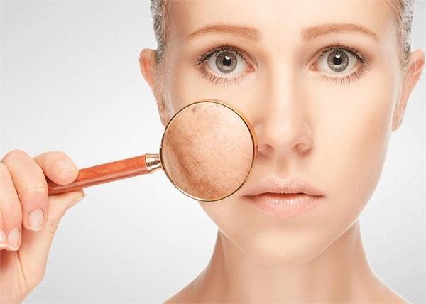 चेहरे की झाइयों का कारण जानकर ऐसे करें इलाज