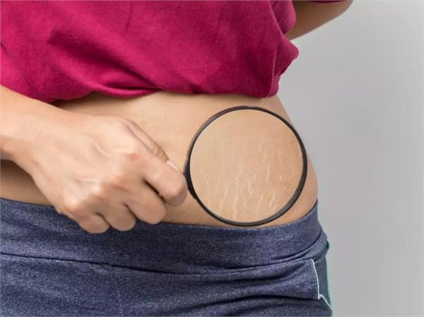 प्रेगनेंसी में क्यों होते हैं Stretch Marks, कैसे पाएं छुटकारा?