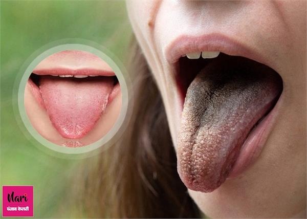 जानिए, किस बीमारी की ओर इशारा करता है आपकी जीभ का बदला रंग