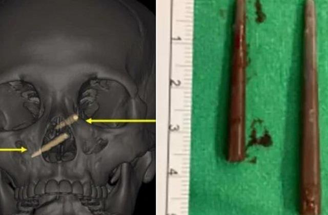 नाक में एक हफ्ते तक फंसे रहे चॉपस्टिक, फिर जो हुआ उसे देख हर कोई रह गया दंग