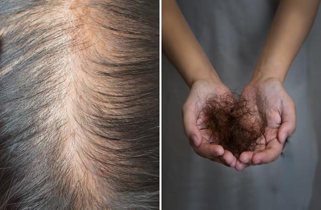 किचन के इन मसालों से झड़ते बाल होंगे बंद, फिर नहीं दिखेगी गंजी खोपड़ी