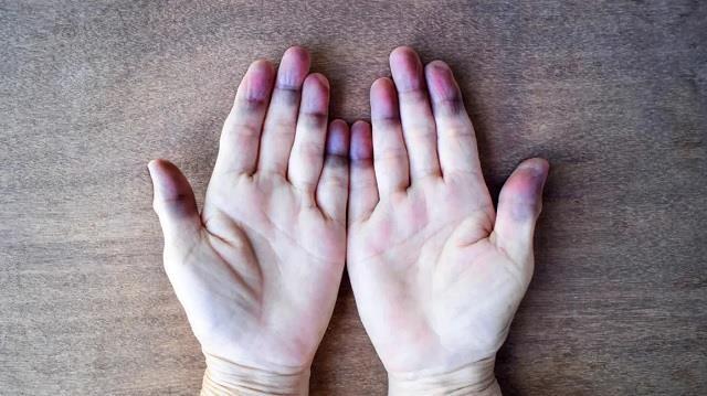 दिल और फेफड़ों की बीमारियों का संकेत देती हैं आपकी उंगलियां, जांच करवाना जरूरी