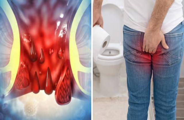 सालों पुरानी बवासीर एक हफ्ते में गायब! बस आज़माएं ये असरदार घरेलू नुस्खे