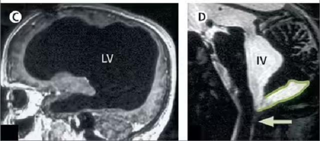 90% दिमाग खत्म, फिर भी जिंदा था इंसान: CT Scan देख डॉक्टरों ने कहा  