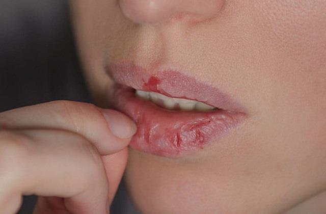 सुबह उठते ही होंठ फटे-फटे लगते हैं? बस रात में सोने से पहले करें ये केयर!