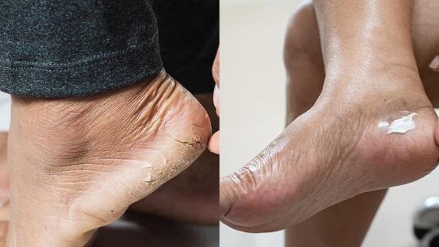 किस विटामिन की कमी से फटती हैं एड़ियां? डॉक्टर ने बताए 5 बड़े कारण