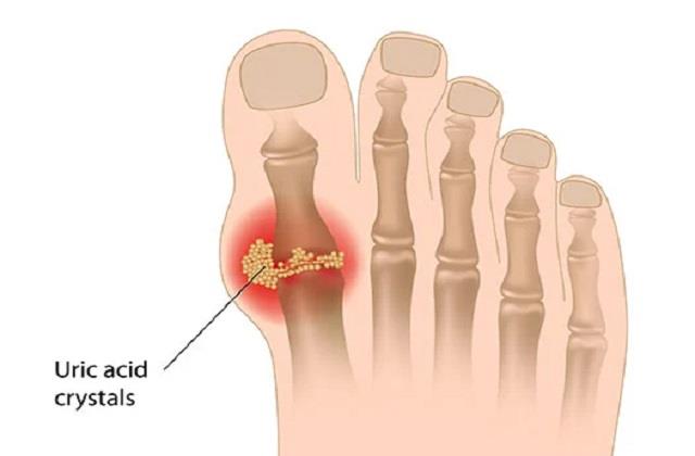 Uric Acid से परेशान लोगों ने दवाइयां नहीं खानी तो ये Food जरूर खाएं