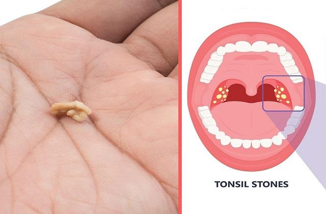 Tonsil Stone बने तो लापरवाही ना बरतें, गले में चिपके सफेद दानों को हटाने का देसी इलाज