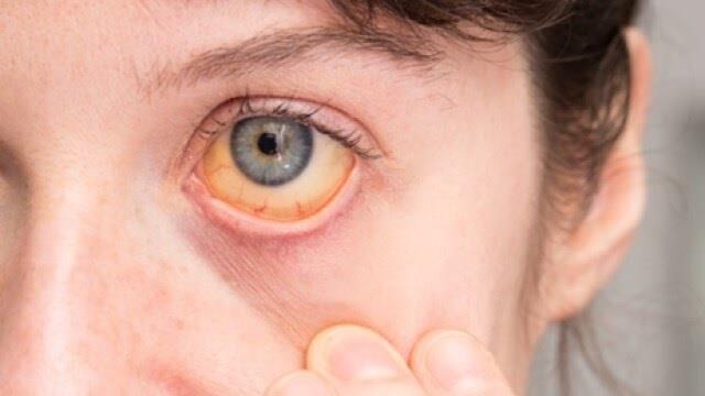 आंख का कैंसर कैसे शुरू होता है? जानिए Eye Cancer के शुरुआती लक्षण