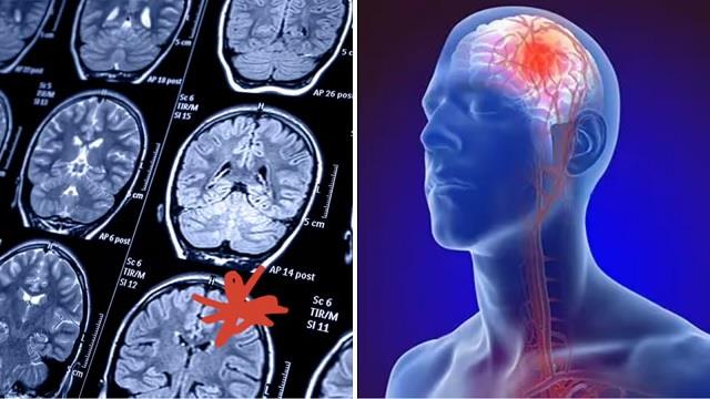 स्ट्रोक के 1 महीने पहले दिखने लगते हैं ये 5 बड़े लक्षण, जल्दी करें 2 काम, बच जाएगी  जान