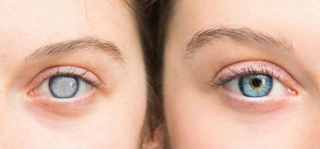 यह हैं मोतियाबिंद के शुरुआती संकेत, नजरअंदाज किया तो बाद में पछताना पड़ेगा