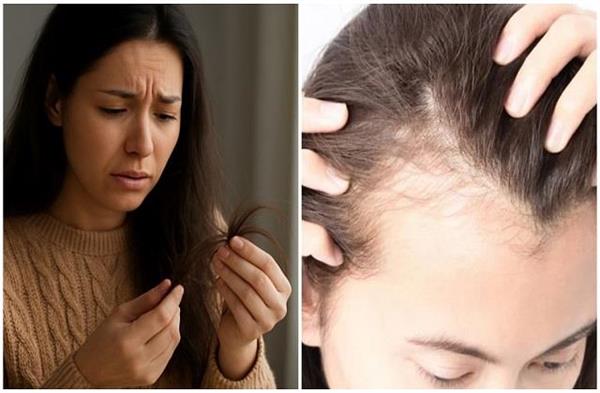 सर्दियों में छोटी सी भूल से झड़ सकते हैं आपके बाल, गीले बाल ढकने से बढ़ रहा ‘स्कैल्प रिंगवर्म’ का खतरा!