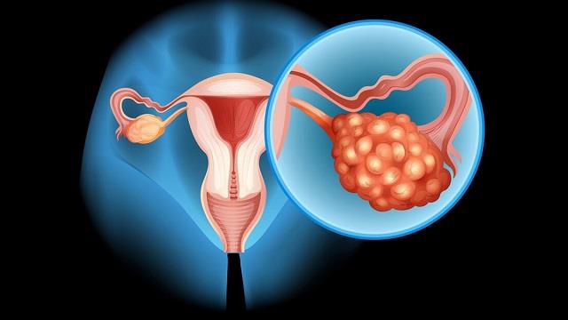 महिलाओं की हंसी छीन सकता है फाइब्रॉइड! राहत पाने के लिए अपनाएं ये आयुर्वेदिक तरीका