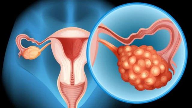 इन आदतों से बढ़ता है ओवेरियन कैंसर का खतरा, जानिए शुरुआती लक्षण