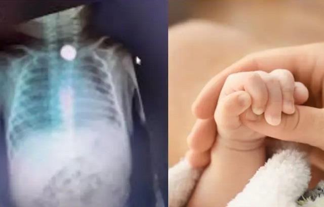 5 महीने के बच्चे की फूड पाइप में फंसी बैटरी, फैला अल्सर-डॉक्टर ने समय रहते बचाई जान