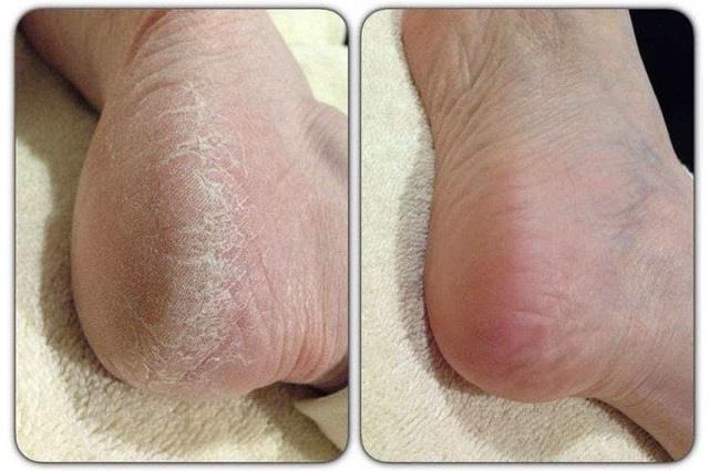 फटी एड़ियों से परेशान तो अपनाएं ये 5 घरेलू नुस्खे, एड़ियां बनेंगी मुलायम और दर्द से मिलेगी राहत